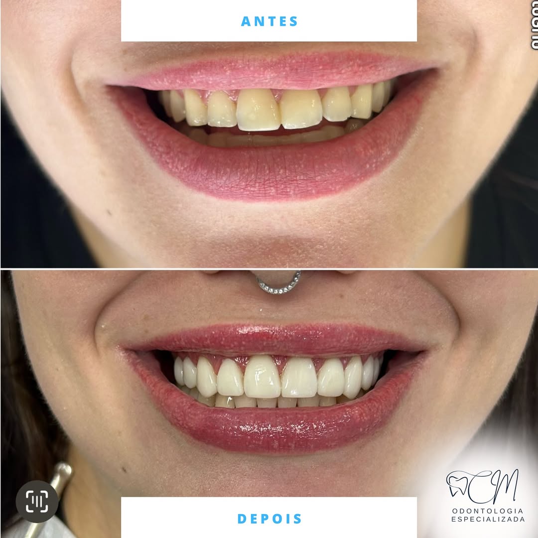 Odontologia Estética — antes e depois